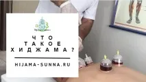 ЩО ТАКЕ ХІДЖАМА, ХІДЖАМА СУННА лікування