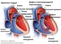 Дефект міжпередсердної перегородки (ДМПП) причини, види, симптоми ДМПП, лікування дефекту міжпередсердної