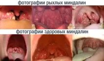 Пухке горло у дитини фото пухких і здорових мигдаликів горло