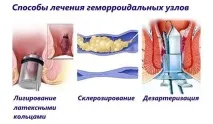 Геморой симптоми, причини, як лікувати гемморою, клініка МДУ ім симптоми