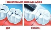 Герметизація фісур постійних зубів у дітей фісур