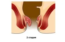 Геморой симптоми, причини, як лікувати гемморою, клініка МДУ ім причини
