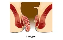 Геморой симптоми, причини, як лікувати гемморою, клініка МДУ ім симптоми