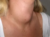 симптоми