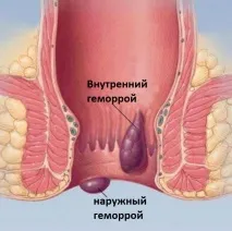 Геморой симптоми, причини, як лікувати гемморою, клініка МДУ ім причини
