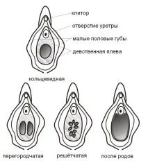 Де знаходиться незаймана плева незаймана