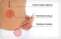 Грижа білої лінії живота під час вагітності причини, симптоми, ускладнення, профілактика живота