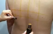 Йодна сітка при болях у спині та шиї через остеохондроз. сітка
