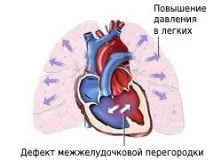 Комплекс Ейзенменгера Ейзенменгера