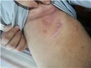 Червоні смуги в паху, 5 відповідей, 0 коментарів, Консультація-форум «Дерматологія та венерологія, коментарів
