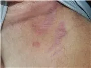 Червоні смуги в паху, 5 відповідей, 0 коментарів, Консультація-форум «Дерматологія та венерологія, відповідей