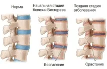 Лікування хвороби Бехтерєва в Ізраїлі лікування