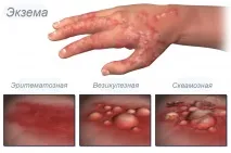Лікування екземи у Німеччині німеччині