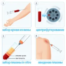 Лікування артрозів (PRP-терапія), ГКБ №13 лікування
