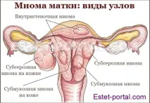 Міома матки варто боятися цієї пухлини міома