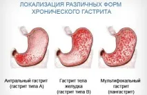Гострий гастрит симптоми, лікування дорослих та дітей, що можна їсти, дієта симптоми