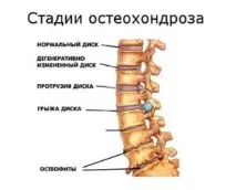 ОСТЕОХОНДРОЗ ШІЙНОГО ВІДДІЛУ, ХРУСТ У ШИЇ шійного