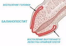 вуздечки