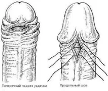 плоті