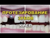 Протезування зубів Київ ціна 2019 року види протези ЛюміДент, Все найкраще стоматологічне лікування зубів