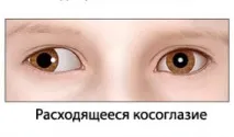 Косоокість, що розходиться, у дітей і дорослих дорослих