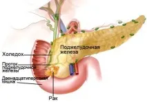 Рак головки підшлункової залози головки