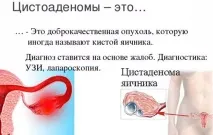 Серозна кіста яєчника що це таке, симптоми та лікування муцинозної цистаденоми серозна