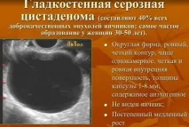 Серозна кіста яєчника що це таке, симптоми та лікування муцинозної цистаденоми таке