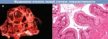 Серозна кіста яєчника що це таке, симптоми та лікування муцинозної цистаденоми симптоми