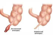 Симптоми апендициту у дітей треба робити батькам симптоми