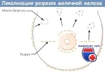 Стереотаксична пункційна біопсія (СПБ) молочної залози пункційна