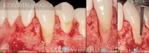 STOMWEB - Стаття - Латеральне зміщення кількох клаптів із зубоясенних сосочків з метою зміщення