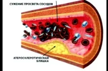інсульту