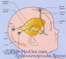 Хірургічні ускладнення шунтування шлуночків мозку шунтування
