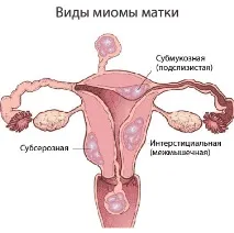 міома