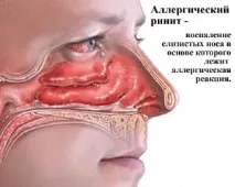 Алергічні риніт симптоми та лікування алергічні