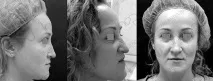 Безопераційна ринопластика, клінічний досвід, проведення процедури, результати, Портал процедури