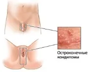 Бородавки на статевому члені симптоми та методи рятування статевому