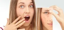 Лікування акне на Ленінському пр, ст лікування