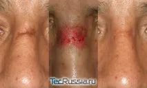 Дермабразія обличчя механічна, лазерна, алмазна механічна
