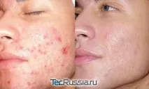 Дермабразія обличчя механічна, лазерна, алмазна обличчя