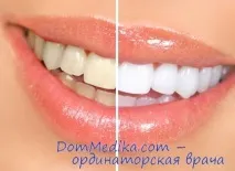 Доступні методи відбілювання зубів секрети стоматологів та домашні рецепти методи