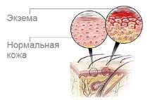Екзема на ногах фото, методи лікування, причини та симптоми методи