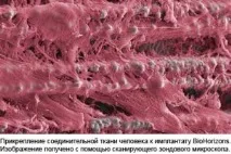 імплантату