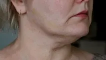 Позбутися другого підбродка позбутися