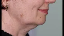 Позбутися другого підбродка позбутися