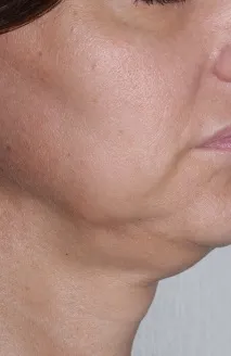 Позбутися другого підбродка другого