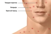 Як ефективно лікувати вітрянку у дітей – список кремів лікувати