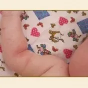 Як лікувати пітницю у дорослих та дітей дітей