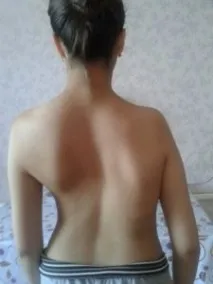 Як виявляє себе і лікується сколіоз 3 ступеня лікується